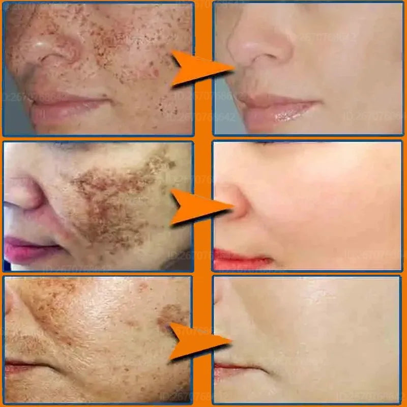 Face Quick Freckles Removal Cream Whitening Fade Spots Emulsion Remove Melasma Brighten Cream for Dark Skin Women Whiten Product