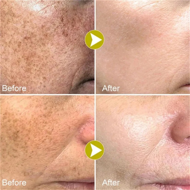 Face Quick Freckles Removal Cream Whitening Fade Spots Emulsion Remove Melasma Brighten Cream for Dark Skin Women Whiten Product